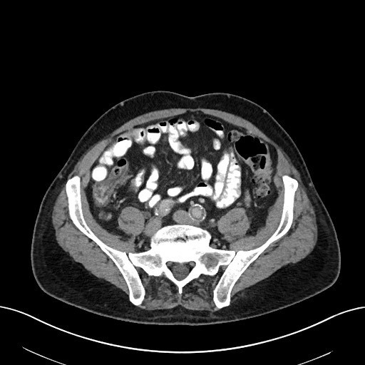 File:Active lower gastrointestinal bleeding - diverticular (Radiopaedia 61203-69106 Axial C+ portal venous phase 89).jpg