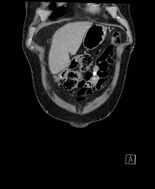 Active lower gastrointestinal bleeding - diverticular (Radiopaedia 61203-69106 Coronal C+ portal venous phase 19).jpg