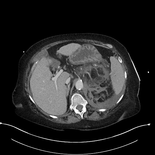 File:Active renal extravasation with large subcapsular and retroperitoneal hemorrhage (Radiopaedia 60975-68796 Axial 301).jpg