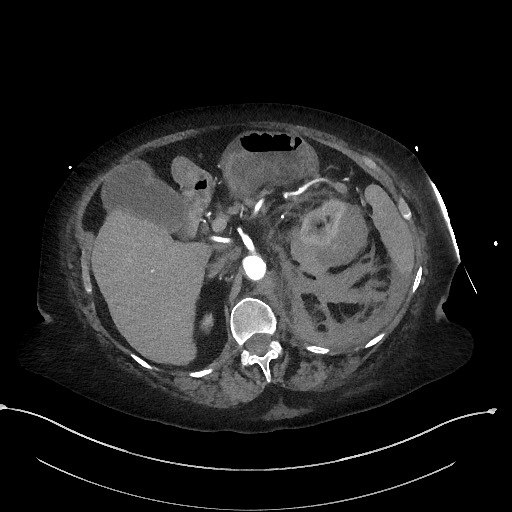 Active renal extravasation with large subcapsular and retroperitoneal hemorrhage (Radiopaedia 60975-68796 Axial C+ arterial phase 65).jpg