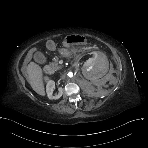 Active renal extravasation with large subcapsular and retroperitoneal hemorrhage (Radiopaedia 60975-68796 Axial C+ arterial phase 77).jpg