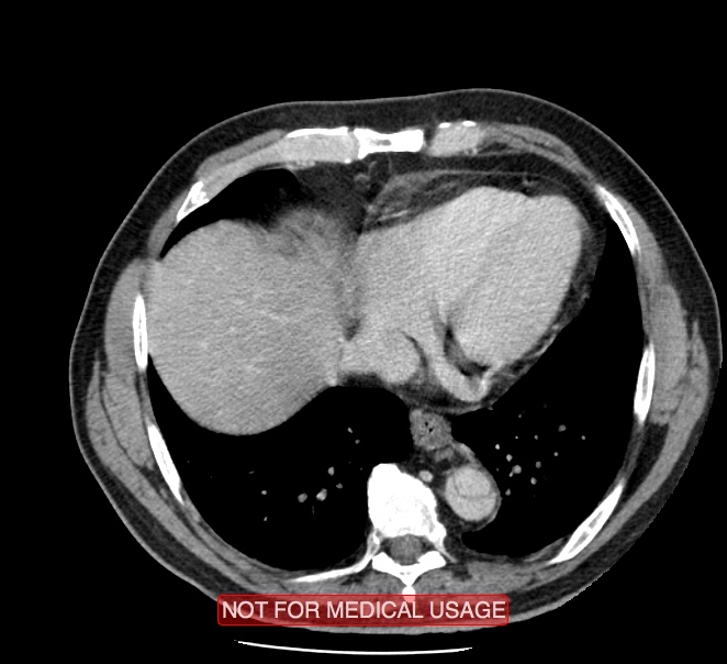 Acute aortic dissection - Stanford type A (Radiopaedia 40661-43285 Axial C+ portal venous phase 45).jpg