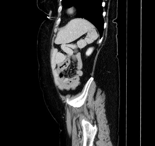 Acute appendicitis, heterotaxy syndrome (Radiopaedia 66884-76202 Sagittal C+ portal venous phase 105).jpg