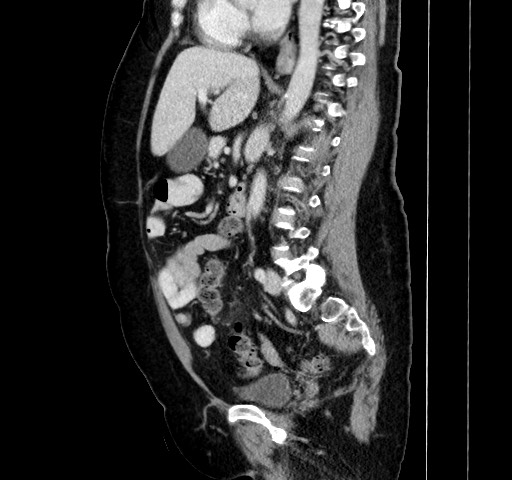 Acute appendicitis, heterotaxy syndrome (Radiopaedia 66884-76202 Sagittal C+ portal venous phase 77).jpg
