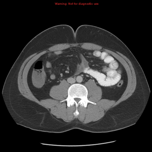 Acute appendicitis (Radiopaedia 10498-10973 Axial C+ portal venous phase 1).jpg