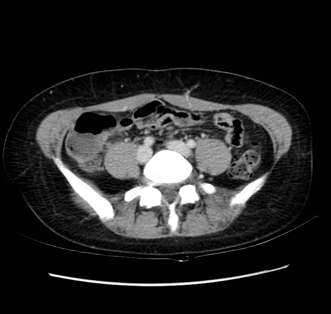 Acute appendicitis (Radiopaedia 22892-22918 Axial C+ portal venous phase 54).png