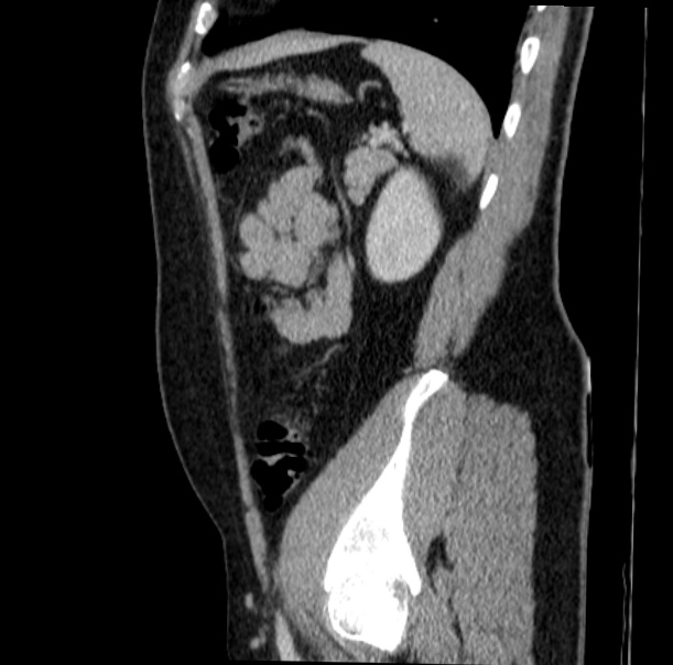 Acute appendicitis (Radiopaedia 38255-40270 Sagittal C+ portal venous phase 64).jpg