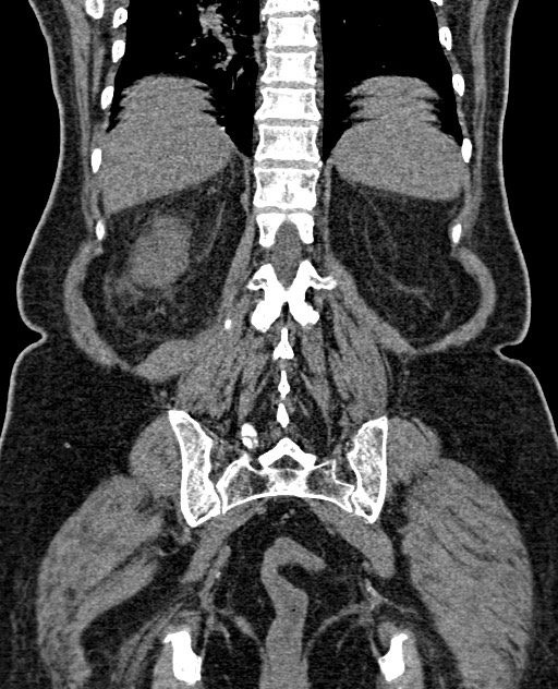 Acute appendicitis (Radiopaedia 58627-65818 Coronal non-contrast 53).jpg