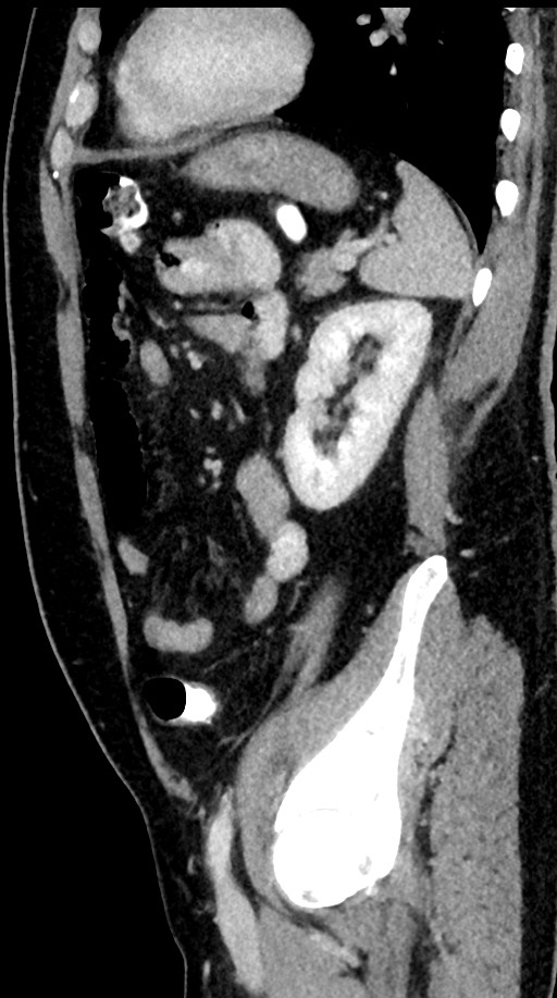 Acute appendicitis (Radiopaedia 77016-88960 Sagittal C+ portal venous phase 34).jpg