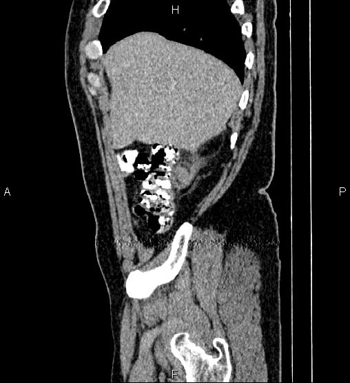 Acute appendicitis (Radiopaedia 84780-100240 Sagittal C+ portal venous phase 13).jpg