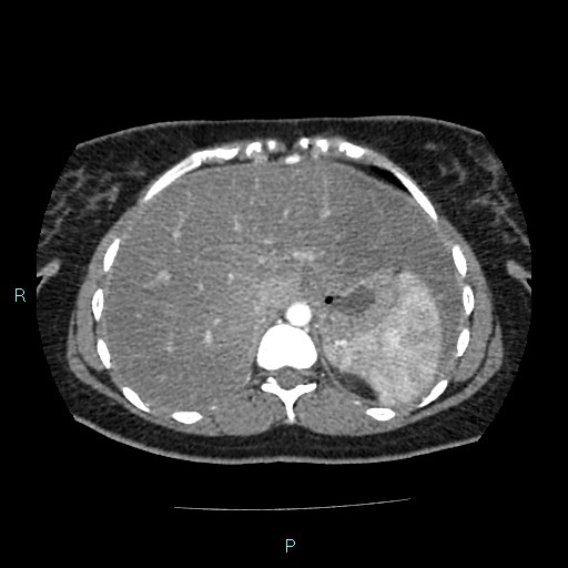Acute bilateral pyelonephritis (Radiopaedia 37146-38881 Axial C+ arterial phase 25).jpg