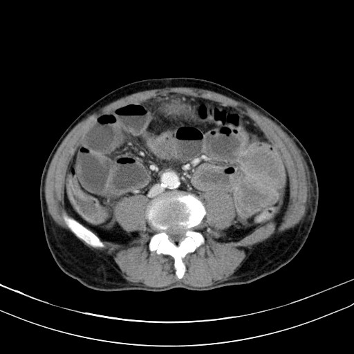 Acute bowel ischemia (Radiopaedia 87695-104114 Axial C+ portal venous phase 53).jpg