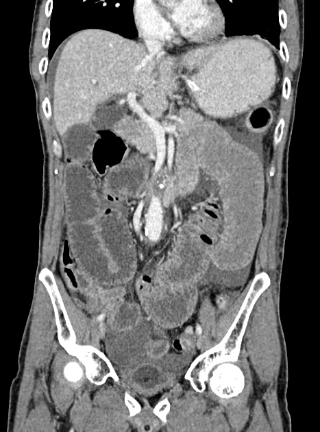 Acute bowel ischemia (Radiopaedia 87695-104114 Coronal C+ portal venous phase 183).jpg