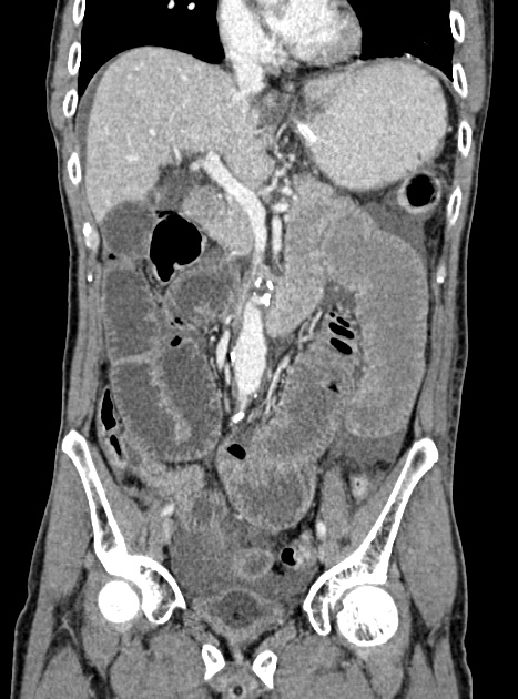 Acute bowel ischemia (Radiopaedia 87695-104114 Coronal C+ portal venous phase 186).jpg
