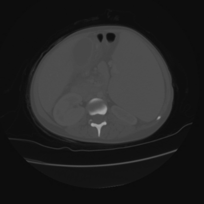 File:Acute calculous cholecystitis in patient with osteopetrosis (Radiopaedia 77871-90159 Axial bone window 23).jpg