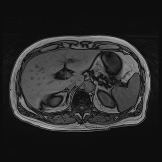File:Acute cholecystitis (Radiopaedia 72392-82923 Axial T1 out-of-phase 43).jpg