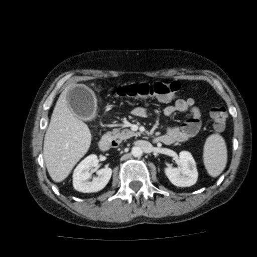 File:Acute cholecystitis and incidental left sided IVC (Radiopaedia 49352-54459 Axial C+ portal venous phase 63).jpg