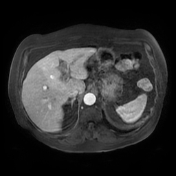 Acute cholecystitis complicated by pylephlebitis (Radiopaedia 65782-74915 Axial arterioportal phase T1 C+ fat sat 38).jpg