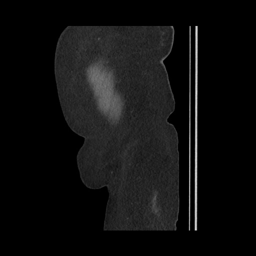 Acute cholecystitis with tensile fundus sign (Radiopaedia 71394-81723 Sagittal non-contrast 156).jpg