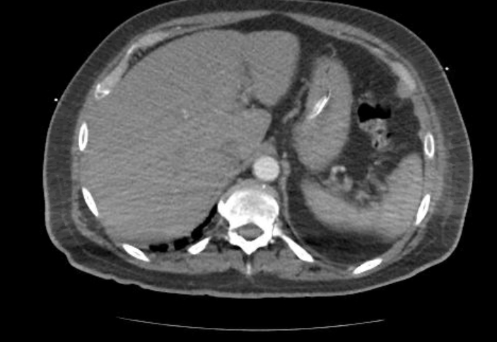File:Acute cor pulmonale (ultrasound) (Radiopaedia 83508-98818 Axial C+ CTPA 82).jpg