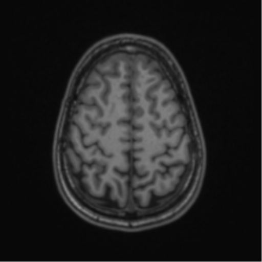 Acute disseminated encephalomyelitis (ADEM) (Radiopaedia 65319-74349 Axial T1 55).png