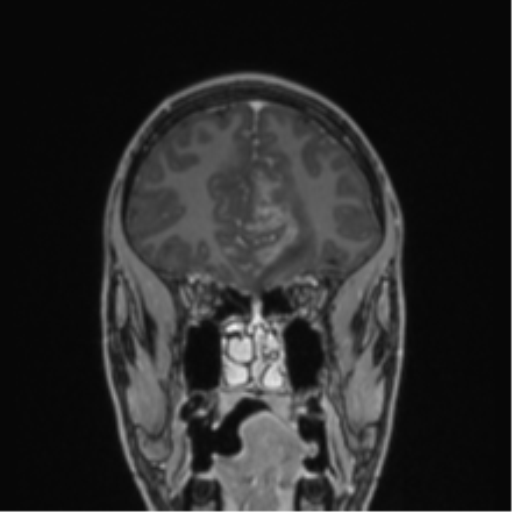 Acute disseminated encephalomyelitis (ADEM) (Radiopaedia 65319-74349 Coronal T1 C+ 48).png