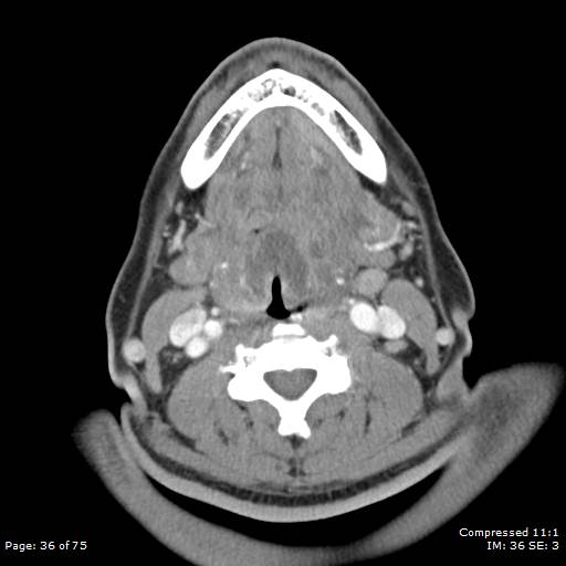 Acute epiglottitis (Radiopaedia 54375-60590 Axial C+ arterial phase 36).jpg
