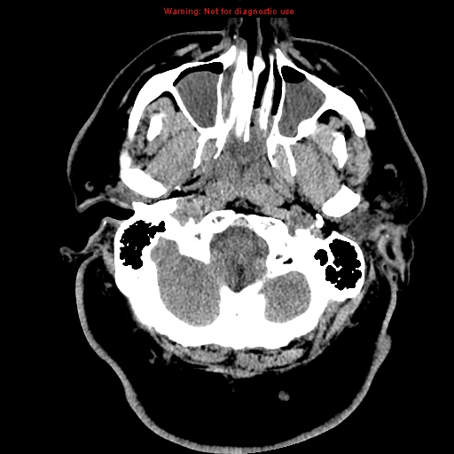 Acute hemorrhagic leukoencephalitis (Radiopaedia 14076-13920 Axial non-contrast 3).jpg