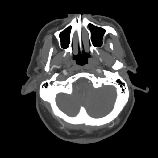File:Acute internal carotid artery dissection (Radiopaedia 53541-59630 D 11).jpg