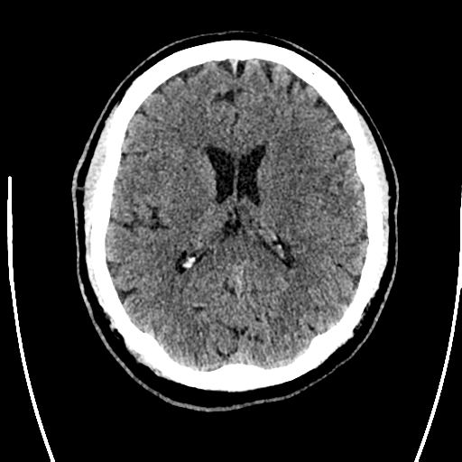 Acute left middle cerebral artery territory ischemic stroke (Radiopaedia 35688-37223 Axial non-contrast 46).png