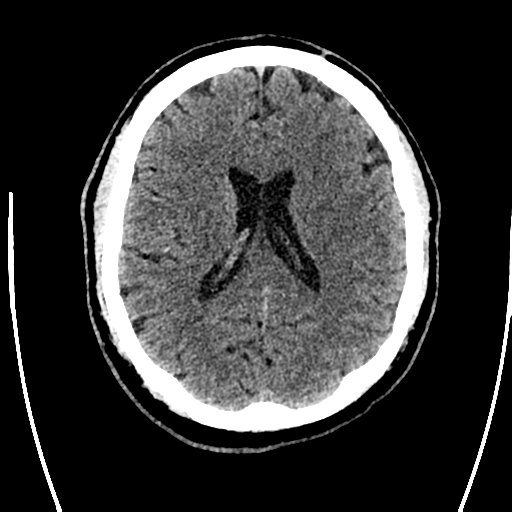 Acute left middle cerebral artery territory ischemic stroke (Radiopaedia 35688-37223 Axial non-contrast 48).png