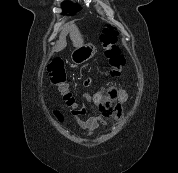 Acute mesenteric ischemia (Radiopaedia 80029-93316 Coronal C+ arterial phase 19).jpg
