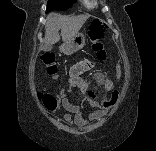 Acute mesenteric ischemia (Radiopaedia 80029-93316 Coronal C+ arterial phase 25).jpg