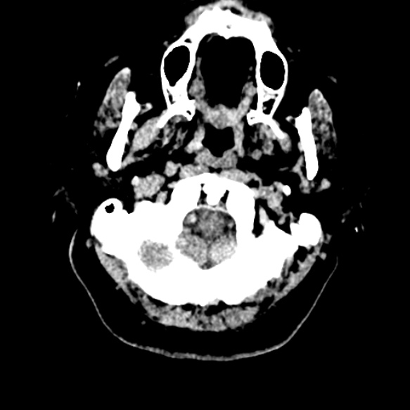 Acute middle cerebral artery territory infarct (Radiopaedia 52380-58283 Axial non-contrast 3).jpg