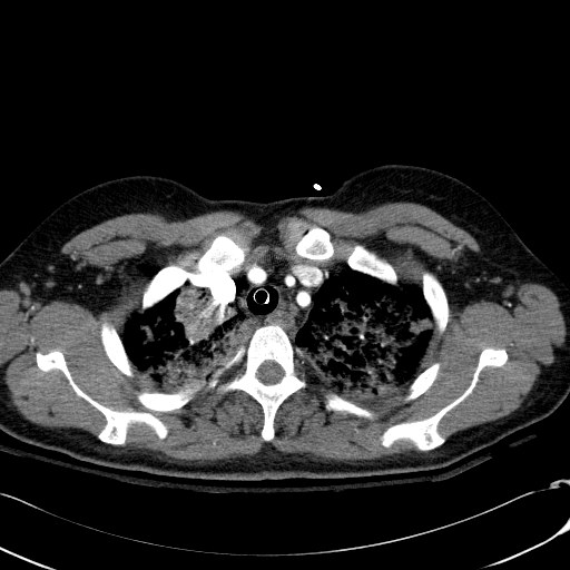 Acute myocardial infarction in CT (Radiopaedia 39947-42415 Axial C+ arterial phase 24).jpg