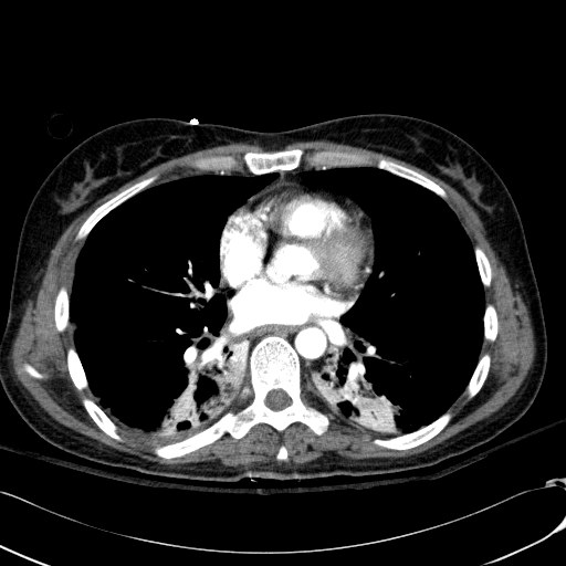 Acute myocardial infarction in CT (Radiopaedia 39947-42415 Axial C+ arterial phase 80).jpg