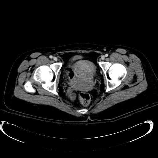 File:Acute myocardial infarction in CT (Radiopaedia 39947-42415 Axial C+ portal venous phase 127).jpg