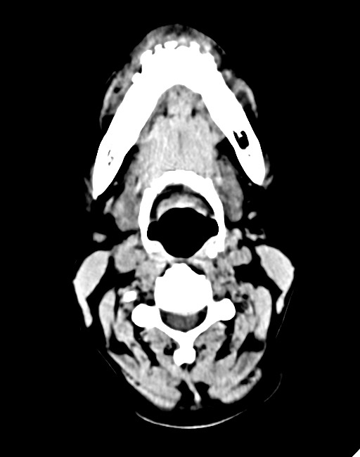 Acute on chronic subdural hematoma (Radiopaedia 74814-85823 Axial non-contrast 8).jpg
