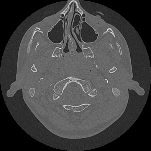 Acute otomastoiditis and Bezold abscess (Radiopaedia 88184-104786 Axial bone window 10).jpg