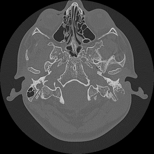 Acute otomastoiditis and Bezold abscess (Radiopaedia 88184-104786 Axial bone window 17).jpg
