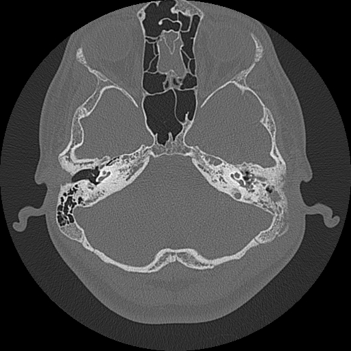 Acute otomastoiditis and Bezold abscess (Radiopaedia 88184-104786 Axial bone window 32).jpg