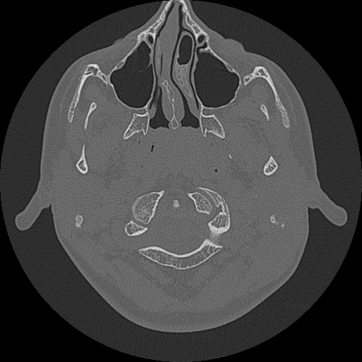 Acute otomastoiditis and Bezold abscess (Radiopaedia 88184-104786 Axial bone window 7).jpg