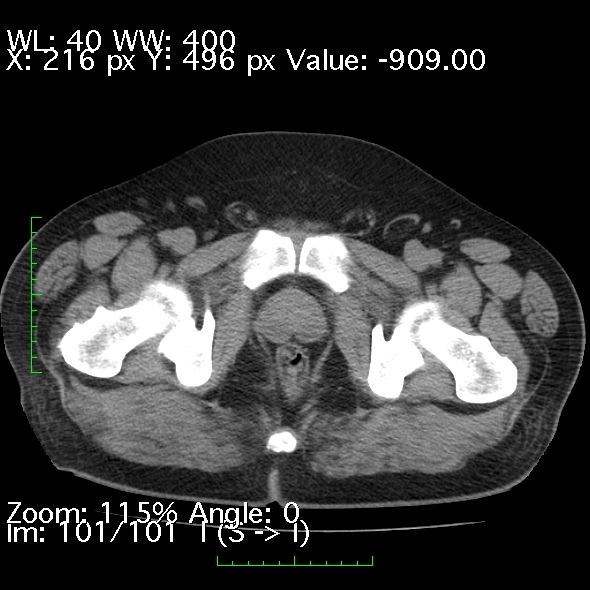 Acute pancreatitis (Radiopaedia 34043-35276 Axial non-contrast 101).jpg