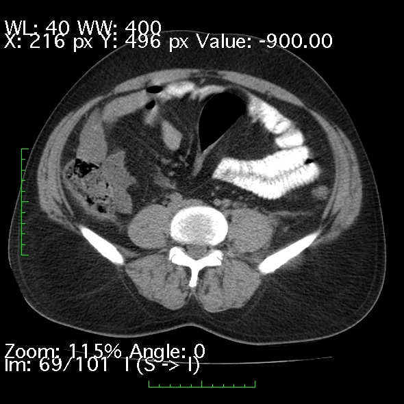 Acute pancreatitis (Radiopaedia 34043-35276 Axial non-contrast 69).jpg