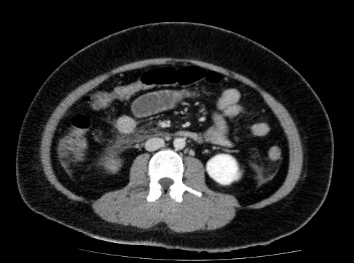 Acute pancreatitis (Radiopaedia 69236-79012 Axial C+ portal venous phase 49).jpg