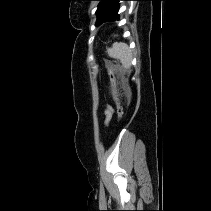 Acute pancreatitis (Radiopaedia 69236-79012 Sagittal C+ portal venous phase 24).jpg