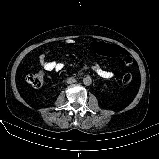 File:Acute pancreatitis (Radiopaedia 85146-100701 Axial non-contrast 68).jpg