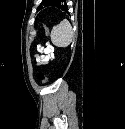Acute pancreatitis (Radiopaedia 85390-101010 Sagittal C+ portal venous phase 93).jpg