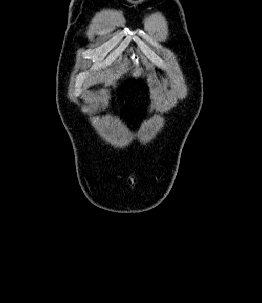 File:Acute pancreatitis (Radiopaedia 87428-103757 Coronal C+ portal venous phase 4).jpg