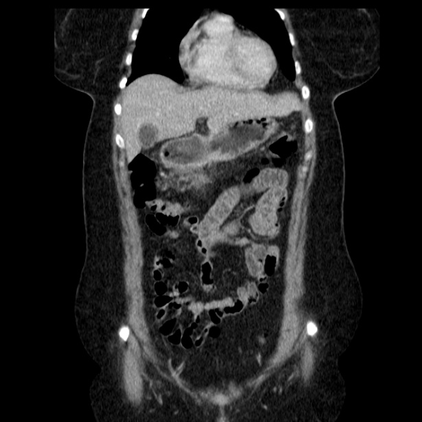 Acute pancreatitis - Balthazar C (Radiopaedia 26569-26714 Coronal C+ portal venous phase 22).jpg